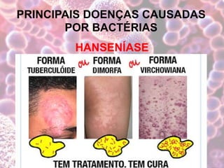 PRINCIPAIS DOENÇAS CAUSADAS
POR BACTÉRIAS
HANSENÍASE
 