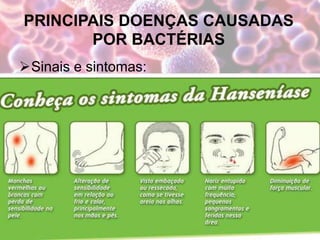 PRINCIPAIS DOENÇAS CAUSADAS
POR BACTÉRIAS
Sinais e sintomas:
 