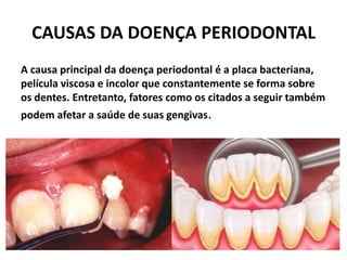 CAUSAS DA DOENÇA PERIODONTAL
A causa principal da doença periodontal é a placa bacteriana,
película viscosa e incolor que constantemente se forma sobre
os dentes. Entretanto, fatores como os citados a seguir também
podem afetar a saúde de suas gengivas.
 