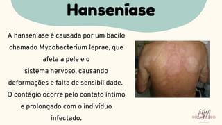 A hanseníase é causada por um bacilo
chamado Mycobacterium leprae, que
afeta a pele e o
sistema nervoso, causando
deformações e falta de sensibilidade.
O contágio ocorre pelo contato íntimo
e prolongado com o indivíduo
infectado.
Hanseníase
LUMA
MONTEIRO
LM
O D O N T O L O G I A
 