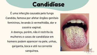 É uma infecção causada pelo fungo
Candida, famosa por afetar órgãos genitais
femininos, levando à vermelhidão, dor e
coceira vaginal.
A doença, porém, não é restrita às
mulheres e casos de candidíase em
homens podem aparecer na pele, unhas,
garganta, boca e até na corrente
sanguínea.
Candidíase
LUMA
MONTEIRO
LM
O D O N T O L O G I A
 
