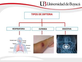 TIPOS DE DIFTERIA
RESPIRATORIA CUTANEA DIGESTIVA
 
