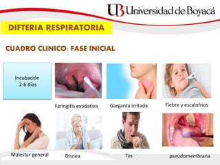 CUADRO CLINICO: FASE INICIAL
Faringitis exudativa Garganta irritada Fiebre y escalofrios
Malestar general Disnea Tos
Incubación
2-6 días
pseudomembrana
DIFTERIA RESPIRATORIA
 