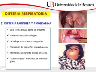 DIFTERIA RESPIRATORIA
2. DIFTERIA FARINGEA Y AMIGDALINA
 Es la forma clásica como se presenta
 Inicia con exudado faríngeo.
 La faringe se encuentra congestiva
 Formación de pequeñas placas blancas
 Membrana adherente blanco-grisácea
 “cuello de toro” indicativo de infección
grave
 