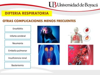 DIFTERIA RESPIRATORIA
OTRAS COMPLICACIONES MENOS FRECUENTES
Neumonía
Insuficiencia renal
Encefalitis
Infarto cerebral
Embolia pulmonar
Bacteriemia
 