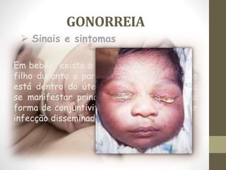GONORREIA
Em bebês existe a transmissão de mãe para
filho durante o parto ou quando este ainda
está dentro do útero, a gonorreia costuma
se manifestar principalmente nos olhos, na
forma de conjuntivite grave, podendo haver
infecção disseminada.
 Sinais e sintomas
 