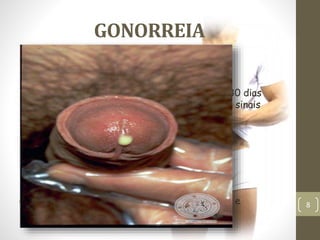 GONORREIA
Nos homens os sintomas, que podem levar até 30 dias
depois da infecção para aparecer, No pênis, os sinais
mais comuns da gonorreia são:
• Dor e ardência ao urinar
• Secreção abundante de pus pela uretra
• Dor ou inchaço em um dos testículos.
Complicações: esterilidade; quadros sistemicos e
complicação cardíacas e nervosas.
 Sinais e sintomas
8
 