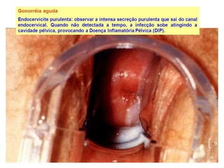 GONORREIA
Nas mulheres ate 70% dos casos são assintomáticos porem
sofrem o risco de desenvolver complicações sérias
independentemente da presença ou severidade dos
sintomas. Os sintomas são:
Aumento no corrimento vaginal, que passa a ter cor
amarelada e odor desagradável
Dor e ardência ao urinar
Sangramento fora do período menstrual
Dores abdominais
Dor pélvica.
• Complicações: infertilidade, Gonorreia disseminada 2% dos
casos, endocardite e meningite.
 Sinais e sintomas
9
 