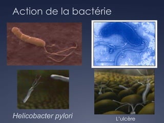Action de la bactérie
L’ulcère
Helicobacter pylori
 