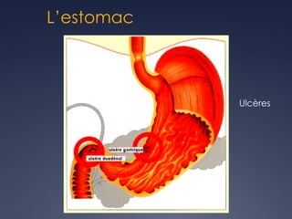 L’estomac
Ulcères
 