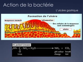 Action de la bactérie
L’ulcère gastrique
Helicobacter pylori
 