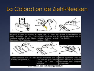 La Coloration de Ziehl-Neelsen
Recouvrir la lame de fuchsine de
Ziehl. Chauffer sur de l’eau
bouillante pendant 8 min. Ajouter
du colorant s’il s’est dissipé.
Après que la lame est
refroidie, décolorer avec la
solution d’alcool acidifié
pendant 10-20 s.
Arrêter la décoloration en
rinçant brièvement avec de
l’eau distillée.
1 3
2
4 5 6
Contre-coloration avec du bleu
de méthylène pendant 30 s.
Rincer brièvement avec de
l’eau distillée pour enlever
l’excès de bleu de
méthylène.
Sécher légèrement avec du
papier bouvard et examiner
directement avec l’objectif
d’immersion.
 