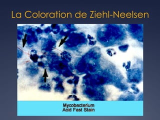 La Coloration de Ziehl-Neelsen
 