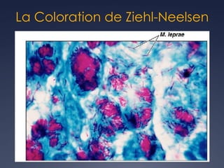 La Coloration de Ziehl-Neelsen
 