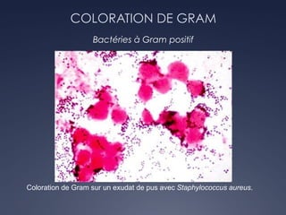 COLORATION DE GRAM
Bactéries à Gram positif
Coloration de Gram sur un exudat de pus avec Staphylococcus aureus.
 