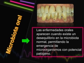 • Las enfermedades orales
aparecen cuando existe un
desequilibrio en la microbiota
normal, permitiendo la
emergencia de
microorganismos con potencial
patógeno.
 