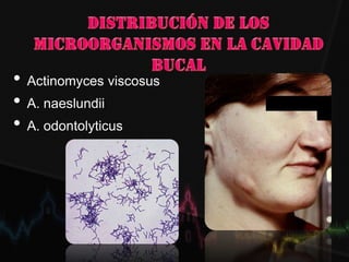 • Actinomyces viscosus
• A. naeslundii
• A. odontolyticus
 