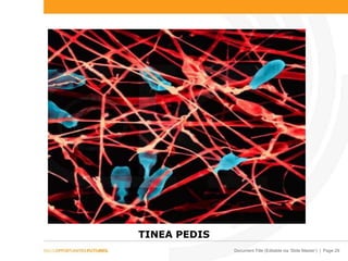 Document Title (Editable via ‘Slide Master’) | Page 29
TINEA PEDIS
 