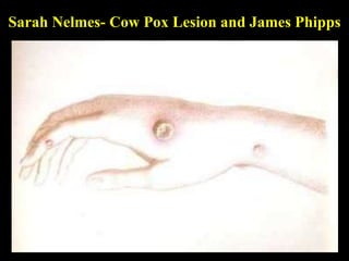 Sarah Nelmes- Cow Pox Lesion and James Phipps 