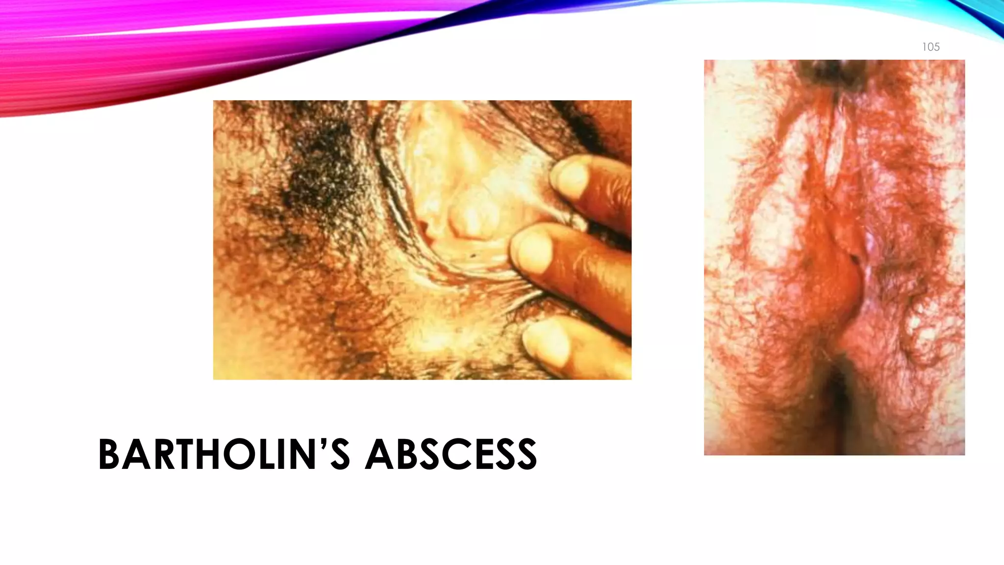 BARTHOLIN’S ABSCESS
105
Clinical Manifestations
 