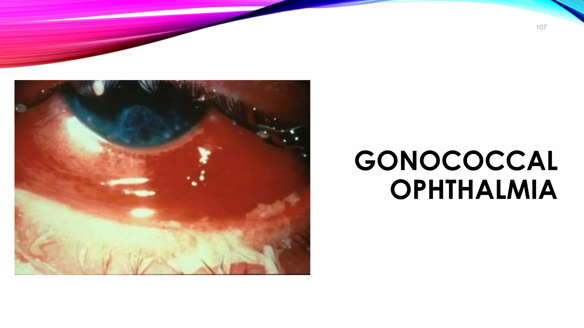 GONOCOCCAL
OPHTHALMIA
107
Clinical Manifestations
 
