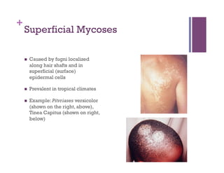 +
    Superficial Mycoses

        Caused by fugni localized
         along hair shafts and in
         superficial (surface)
         epidermal cells

        Prevalent in tropical climates

        Example: Pitvriases versicolor
         (shown on the right, above),
         Tinea Capitus (shown on right,
         below)
 