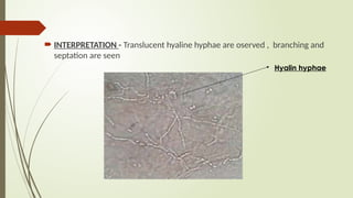  INTERPRETATION - Translucent hyaline hyphae are oserved , branching and
septation are seen
Hyalin hyphae
 