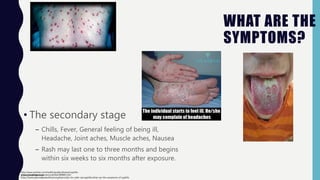 WHAT ARE THE
SYMPTOMS?
• The secondary stage
– Chills, Fever, General feeling of being ill,
Headache, Joint aches, Muscle aches, Nausea
– Rash may last one to three months and begins
within six weeks to six months after exposure.
https://www.plannedparenthood.org/learn/stds-hiv-safer-sex/syphilis/what-are-the-symptoms-of-syphilis
https://medlineplus.gov/ency/article/000861.htm
http://www.nytimes.com/health/guides/disease/syphilis-
primary/overview.html
 