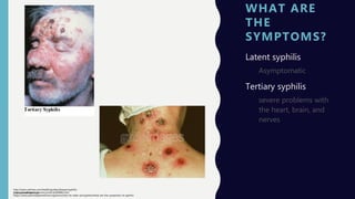 WHAT ARE
THE
SYMPTOMS?
Latent syphilis
Asymptomatic
Tertiary syphilis
severe problems with
the heart, brain, and
nerves
https://www.plannedparenthood.org/learn/stds-hiv-safer-sex/syphilis/what-are-the-symptoms-of-syphilis
https://medlineplus.gov/ency/article/000861.htm
http://www.nytimes.com/health/guides/disease/syphilis-
primary/overview.html
 