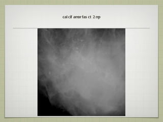 calcif amorfas ct 2 mp 