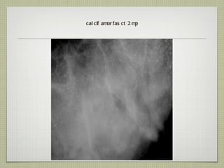 calcif amorfas ct 2 mp 