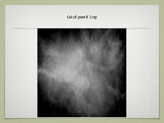 Calcif puntif 2 mp 