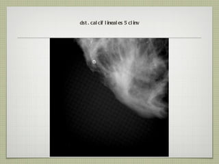 dst. calcif lineales 5 clinv 