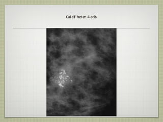 Calcif heter 4 cdis 