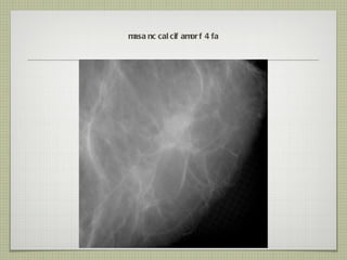 masa nc calcif amorf 4 fa 
