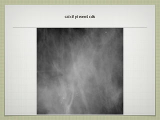 calcif pleom 4 cdis 