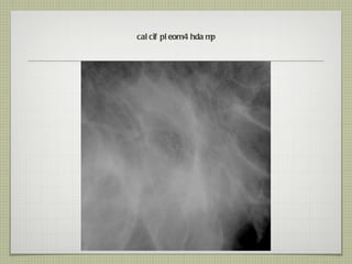 calcif pleom 4 hda mp 