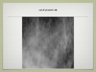 calcif pleom 5 cdis 