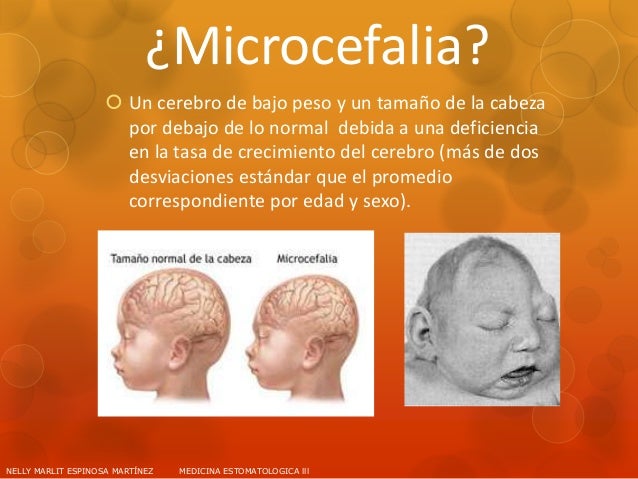 Microcefalia