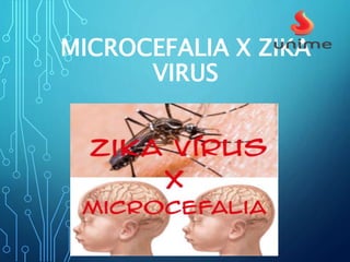 MICROCEFALIA X ZIKA
VIRUS
 