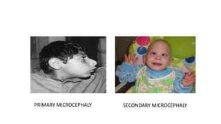 PRIMARY MICROCEPHALY SECONDARY MICROCEPHALY
 