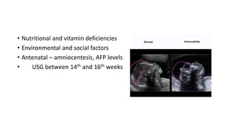 • Nutritional and vitamin deficiencies
• Environmental and social factors
• Antenatal – amniocentesis, AFP levels
• USG between 14th and 16th weeks
 