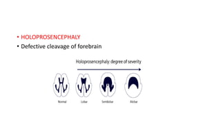 • HOLOPROSENCEPHALY
• Defective cleavage of forebrain
 