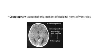 • Colpocephaly- abnormal enlargement of occipital horns of ventricles
 
