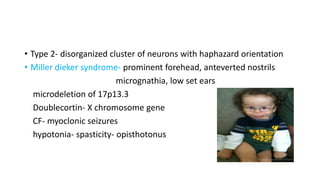 • Type 2- disorganized cluster of neurons with haphazard orientation
• Miller dieker syndrome- prominent forehead, anteverted nostrils
micrognathia, low set ears
microdeletion of 17p13.3
Doublecortin- X chromosome gene
CF- myoclonic seizures
hypotonia- spasticity- opisthotonus
 