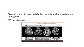 • Bilateral periventricular nodular heterotopia- epilepsy and normal
intelligence
• MRI for diagnosis
 