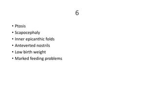 6
• Ptosis
• Scapocephaly
• Inner epicanthic folds
• Anteverted nostrils
• Low birth weight
• Marked feeding problems
 