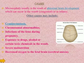  Microcephaly usually is the result of abnormal brain development,
which can occur in the womb (congenital) or in infancy.
Other causes may include:
 Craniosynostosis.
 Chromosomal abnormalities.
 Infections of the fetus during
pregnancy.
 Exposure to drugs, alcohol or
certain toxic chemicals in the womb.
 Severe malnutrition
 Decreased oxygen to the fetal brain (cerebral anoxia).
 