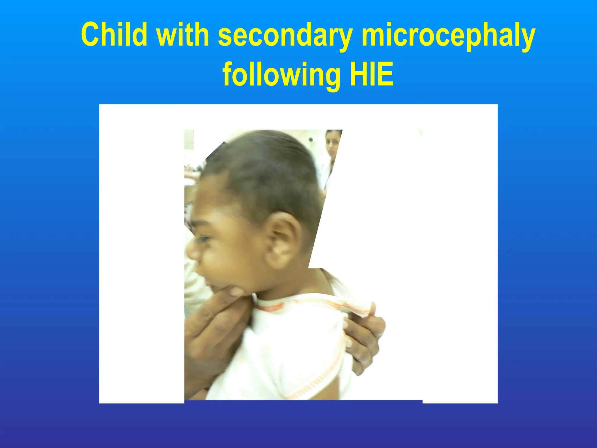 Child with secondary microcephaly
following HIE
 