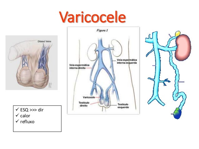 Varicocele Repair - Principals and Microsurgical Technique